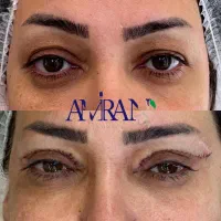 بلفاروپلاستی/جراحی پلک/رفع غبغب