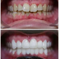 شرایط ویژه کامپوزیت دندان