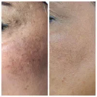 حذف کک و مک در یک جلسه