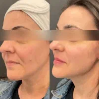 اندولیفت ، لیفت و جوانسازی صورت وگردن توسط پزشک