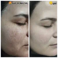 جشنوار یلدا درمان تضمینی کک ومک/لک/خال/فقط در1جلسه|خدمات آرایشگری و زیبایی|اصفهان, باغ زیار|دیوار