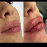 ژل .بوتاکس.انزیم،انواع پرسینگ با بهترین کیفیت.|خدمات آرایشگری و زیبایی|ملایر, |دیوار