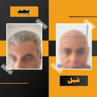 جشنواره نوروزی کاشت مو و ابرو + شرایط اقساط