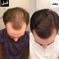 پک تضمینی قطع ریزش مو و رویش مجدد موهای شما