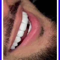 کامپوزیت/دندانپزشکی/عصبکشی/لیرینگ/ترمیم پالیش|خدمات زیبایی و سلامت|تهران, تهرانپارس شرقی|دیوار
