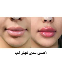 انواع ژل صورت،بوتاکس،مزوژل،مزوتراپی،آنزیم