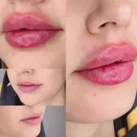 تزریق ژل و فیلر لب،گونه،چانه(جشنواره)درمطب فقط499ت|خدمات آرایشگری و زیبایی|اصفهان, باغ زیار|دیوار