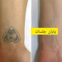 پاک کردن تتو جدیدترین دستگاهای روز دنیا|خدمات آرایشگری و زیبایی|اهواز, نادری|دیوار