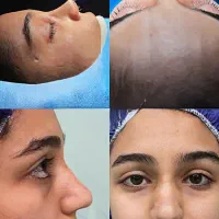 جراحی بینی در تهران با آف ۵۰درصد،جشنواره آذر|خدمات آرایشگری و زیبایی|پاکدشت, پاکدشت (مامازند)|دیوار