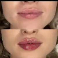 ژل و بوتاکس تضمینی
