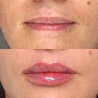 تزریق ژل و بوتاکس|خدمات آرایشگری و زیبایی|قم, صدوق|دیوار