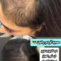 بیا کمکت کنم ریزش موهات درمان بشه