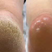 پدیکور تضمینی اپیلاسیون باوکس باموم