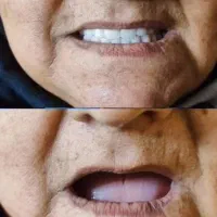 ساخت دندان مصنوعی متحرک فول دنچر