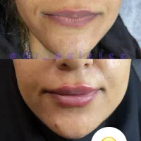 تزریق فیلر و بوتاکس