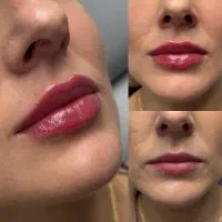 تزریقات زیبایی با تخفیف روز پزشک