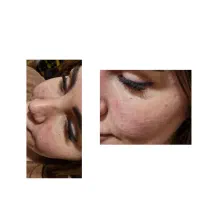 تزریق بوتاکس و ژل اصل باکیفیت تخفیف عیدانه