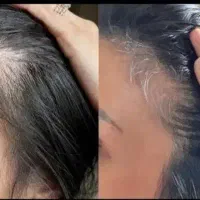 قطع مشکلات مربوط به ریزش مو|آرایشی، بهداشتی، درمانی|تهران, شهرک آزمایش|دیوار