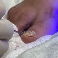 پودولوژی، درمان ناخن، داخل گوشت رفته، قارچی، میخچه