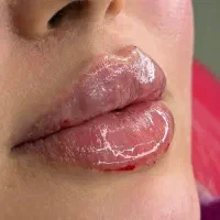 جشنواره ژل لب گونه چونه زاویه فک فیلرزیرچشم بوتاکس|خدمات آرایشگری و زیبایی|تهران, قلهک|دیوار