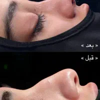 عمل بینی با چک صیادی مشاوره رایگان فوقتخصص ENT|خدمات زیبایی و سلامت|تهران, سهروردی|دیوار