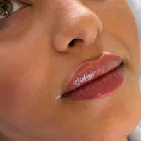 تزریق ژل و بوتاکس توسط پزشک