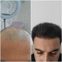 کاشت مو و ریش تحت نظر پزشک متخصص