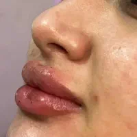 تزریق ژل وبوتاکس تزریق چربی صورت وباسن|خدمات زیبایی و سلامت|تهران, شهرک فردوس (حسینی)|دیوار
