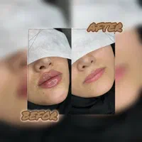 جشنواره مدلینگ ۱۰ سی سی امروز۳۸۰۰فیلر لب لیفت ابرو