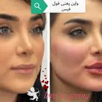 فیلرزیر چشم، زاویهفک، لیفت شقیقه، بوتاکس، لب نچرال|خدمات آرایشگری و زیبایی|مشهد, سرافرازان|دیوار