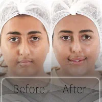 جوانسازی و لیفت بدون جراحی|خدمات آرایشگری و زیبایی|تهران, اختیاریه|دیوار