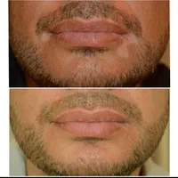 درمان گیاهی بیماری پیسی وپسوریازیس|خدمات آرایشگری و زیبایی|مشهد, امام رضا (ع)|دیوار