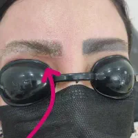 جشنواره لیزر ریمو تتو ابرو وبدن در مطب پزشک