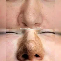 (کوچک کردن بینی فقط با1جلسه) 965تومان