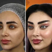 مدل زیبا وجوانسازی شفاف سازی لیف صورت به مدت محدود