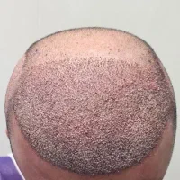 کاشت مو با تراکم بالا