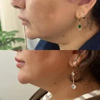 تزریق ژل و بوتاکس فقط۷۵۰|خدمات آرایشگری و زیبایی|هشتگرد, شهرک راه آهن|دیوار