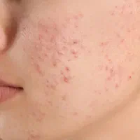 درمان انواع مشکلات پوست و مو|آرایشی، بهداشتی، درمانی|بروجرد, |دیوار