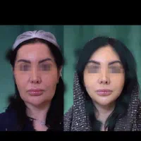 عمل مکس لیفت/لیفت صورت/لیفت تحتانی