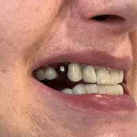 ایمپلنت دیجیتال اقساطی بدون سود در انواع برندها|خدمات آرایشگری و زیبایی|شیراز, زرگری|دیوار