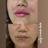 فیلر لب،چونه،گونه،فول فیس،باسن|خدمات آرایشگری و زیبایی|مشهد, سجاد شهر|دیوار