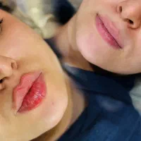 فیلر لب روسی -زاویه سازی -بوتاکس-پی ار پی -مزو