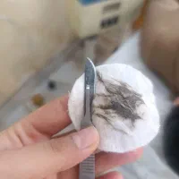 درماپلنینگ وپاکسازی پوست