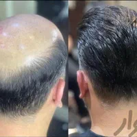 پروتز مو وارداتی ،کاشت hrt|خدمات آرایشگری و زیبایی|اصفهان, گلزار|دیوار