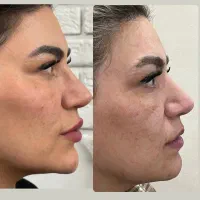 جشنواره فیلرلب زاویه فک بوتاکس،لیفت بانخ،مزووایت