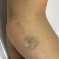 پاککردن تاتو بالیزر