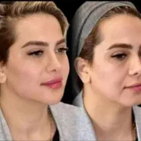 هایفوتراپی14بعدی برای نخستین بار در غرب کشور