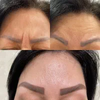 ژل و بوتاکس