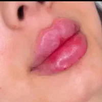 ژل لب و بوتاکس  مدلینگ پرسینگ چالگونه آموزش ژل