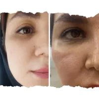 جشنواره تخفیف بهار هایفو تراپی تخصصی